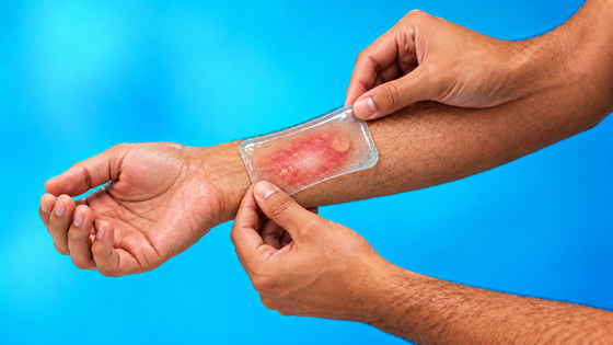 Burn Relief